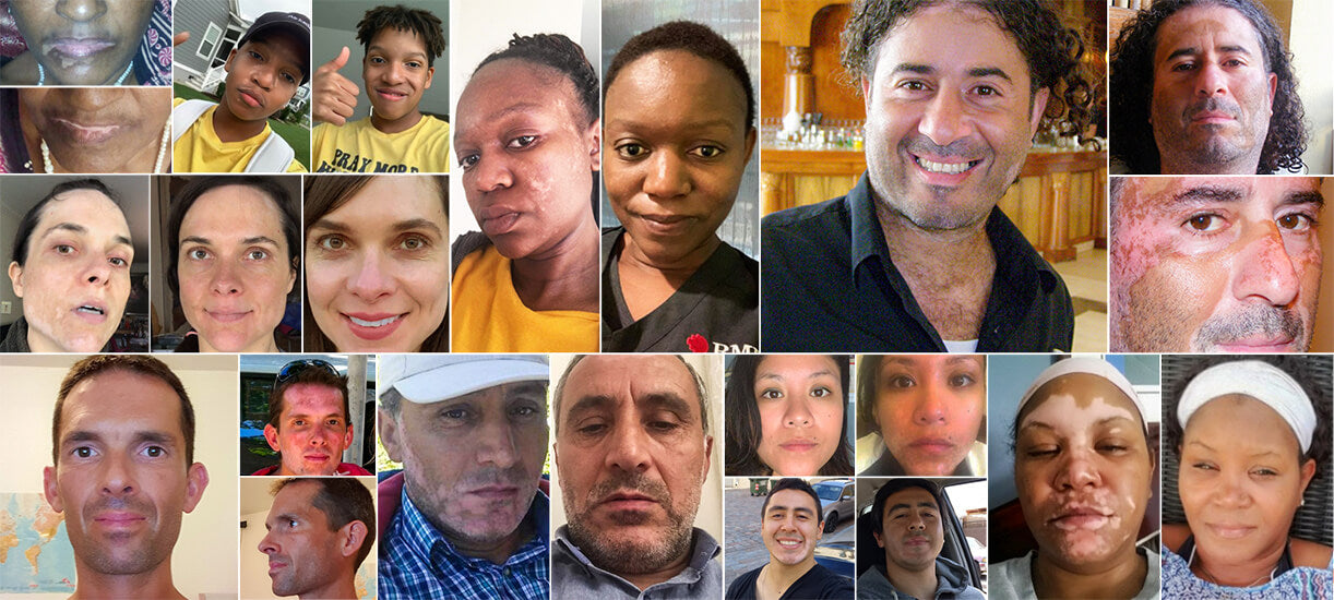 Vitiligo Organics Transform yourself Naturally Before After