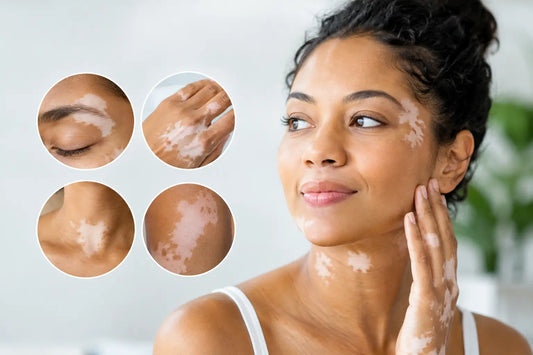 Which Vitiligo Areas Respond First to Care?