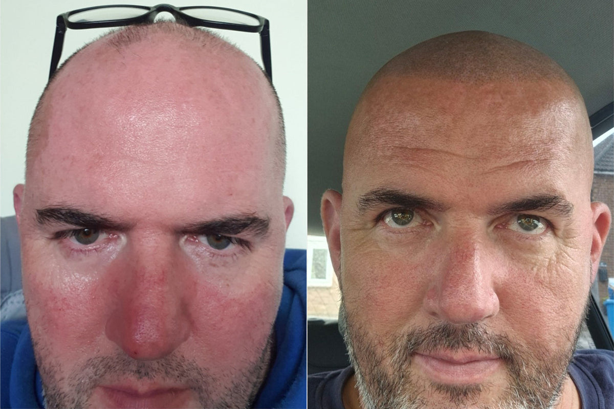 A Facial Vitiligo Customer Transformation