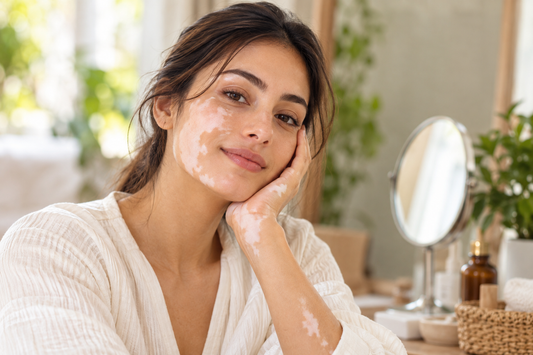 Can Facial Vitiligo Repigment Naturally? What Helps