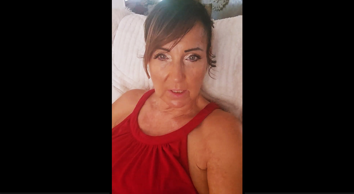 Brigitte’s Vitiligo Story