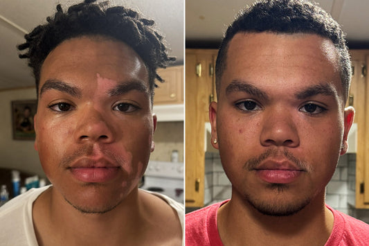 Vitiligo Before and After: What Photos and Real Stories Can Tell You